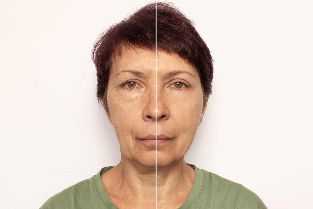 Upper blepharoplasty before and after eyelid rejuvenation