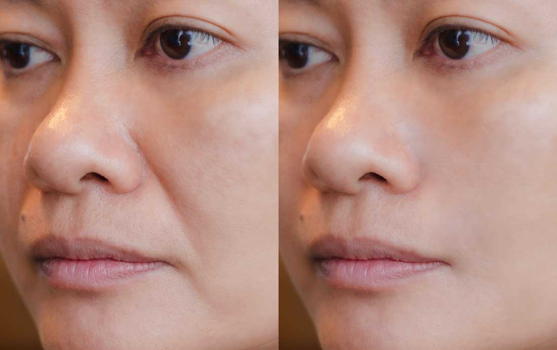 Dermal filler before and after facial enhancement