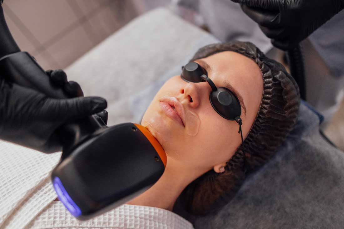 Facial laser hair removal treatment in Charleston, SC