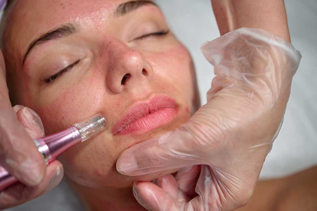 Microneedling treatment stimulating collagen on facial skin