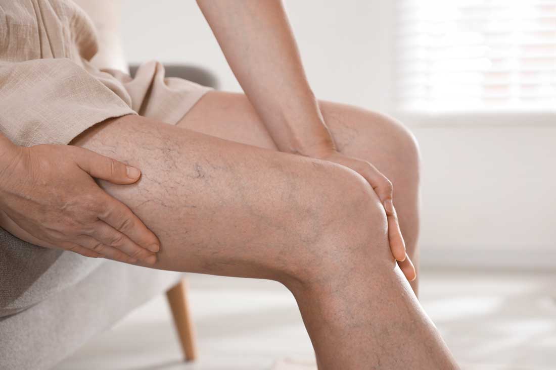 Legs treated with sclerotherapy for spider veins