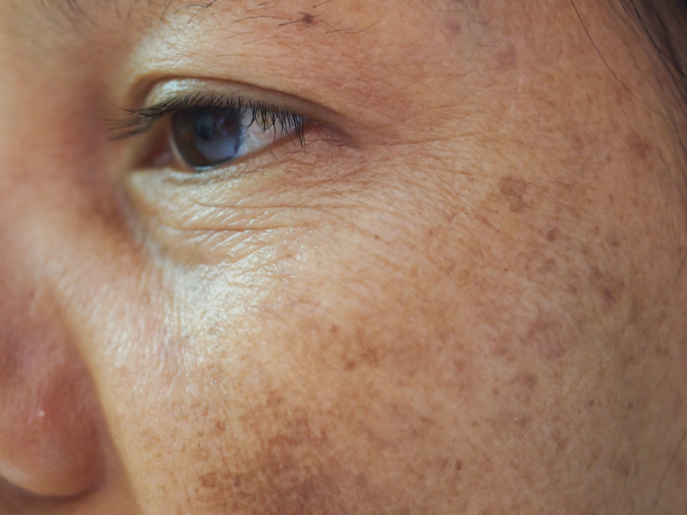 Closeup,dark,spots,melasma,pigmentation,skin,on,face,asian,woman.