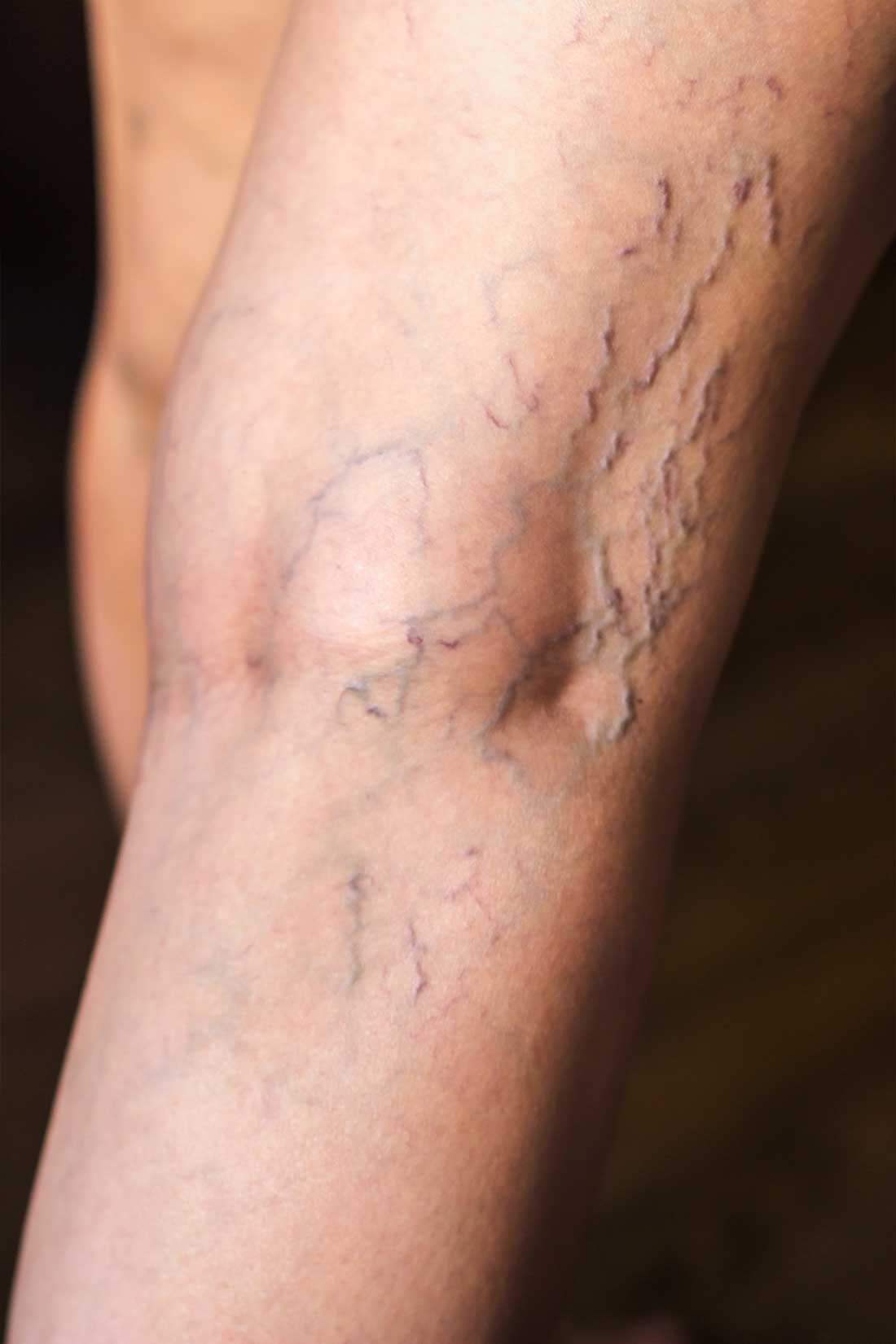 Varicose leg evaluated for sclerotherapy treatment
