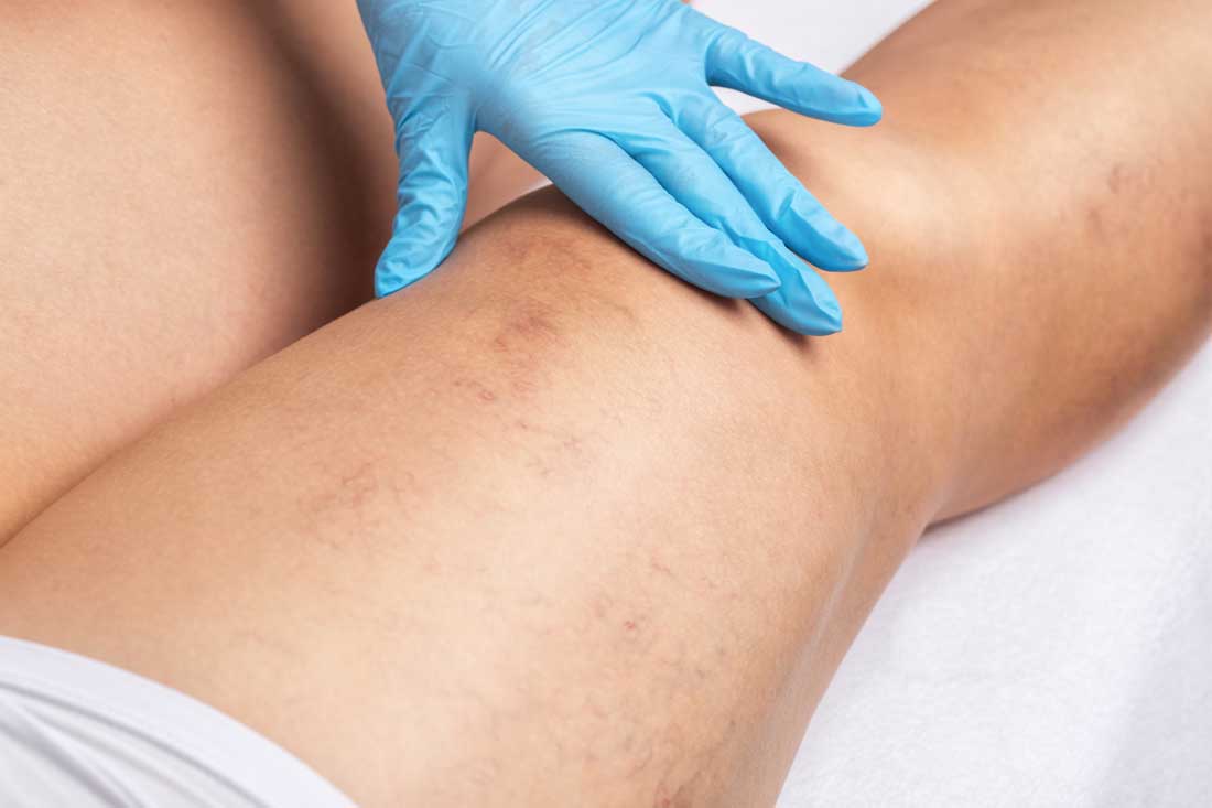 Leg evaluation for personalized sclerotherapy treatment